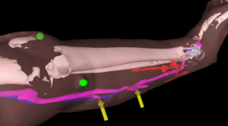 HoloLens used to “see through tissue” in reconstructive surgery study at Imperial College London